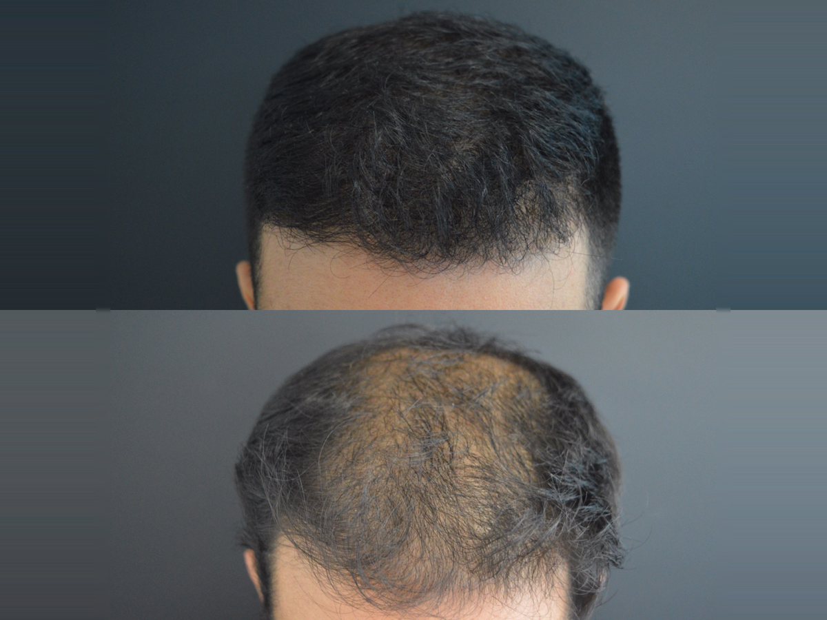 Alopecia Androgenética (Calvície)