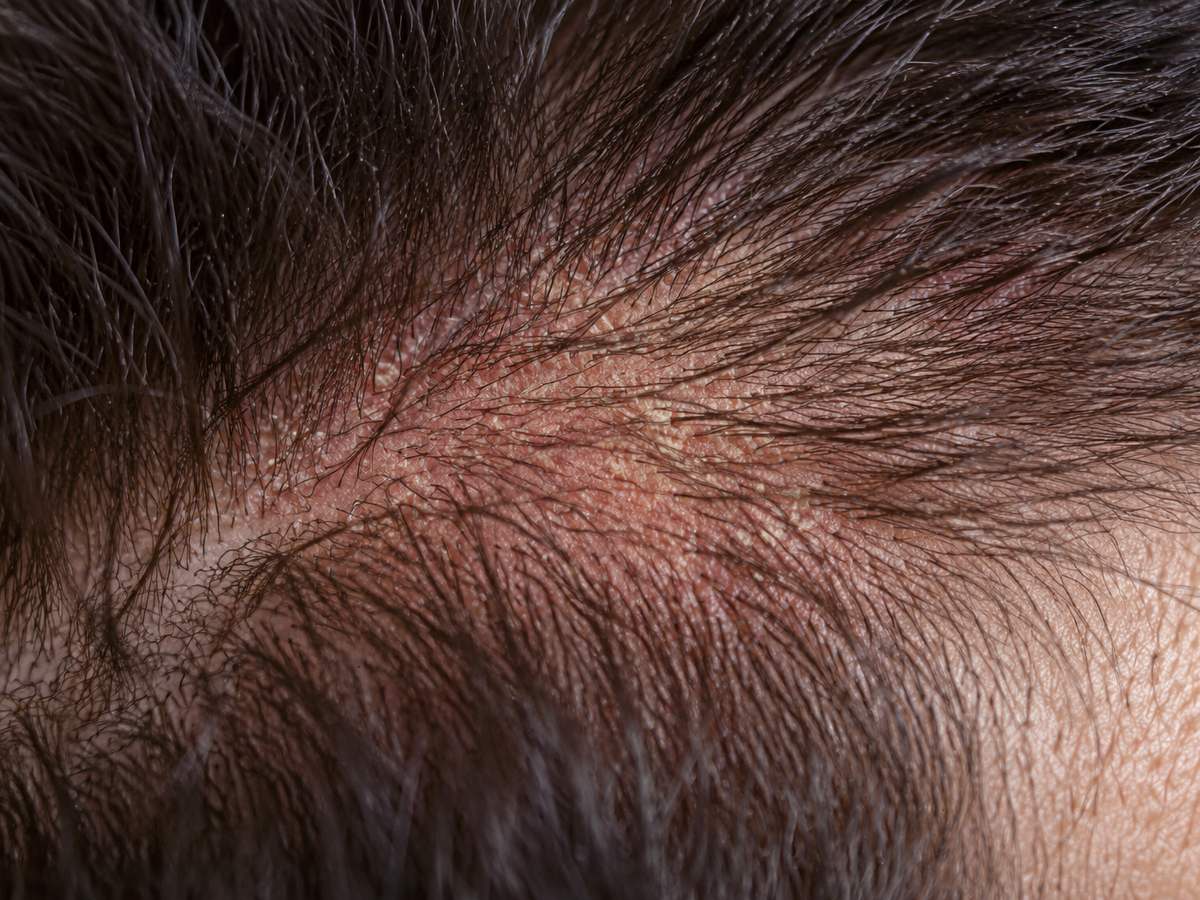 Caspa e Dermatite Seborreica