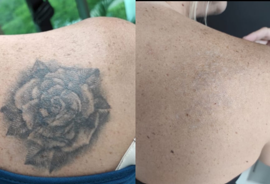 Remoção de Tatuagem