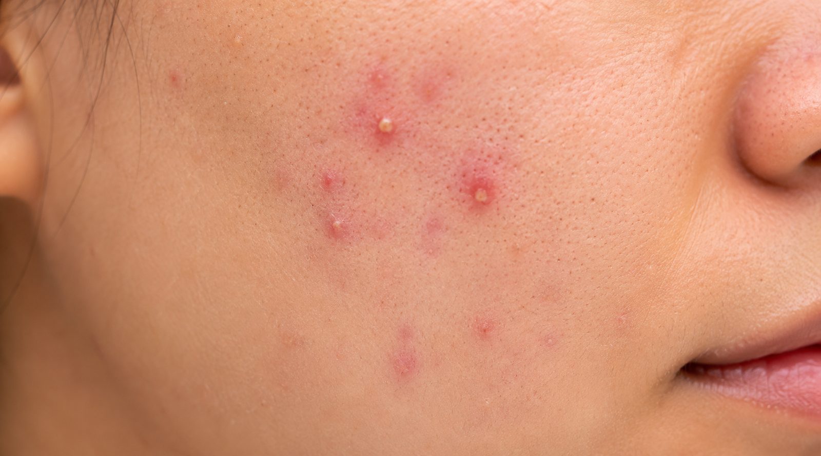 Close-up de lesões inflamatórias de acne na bochecha