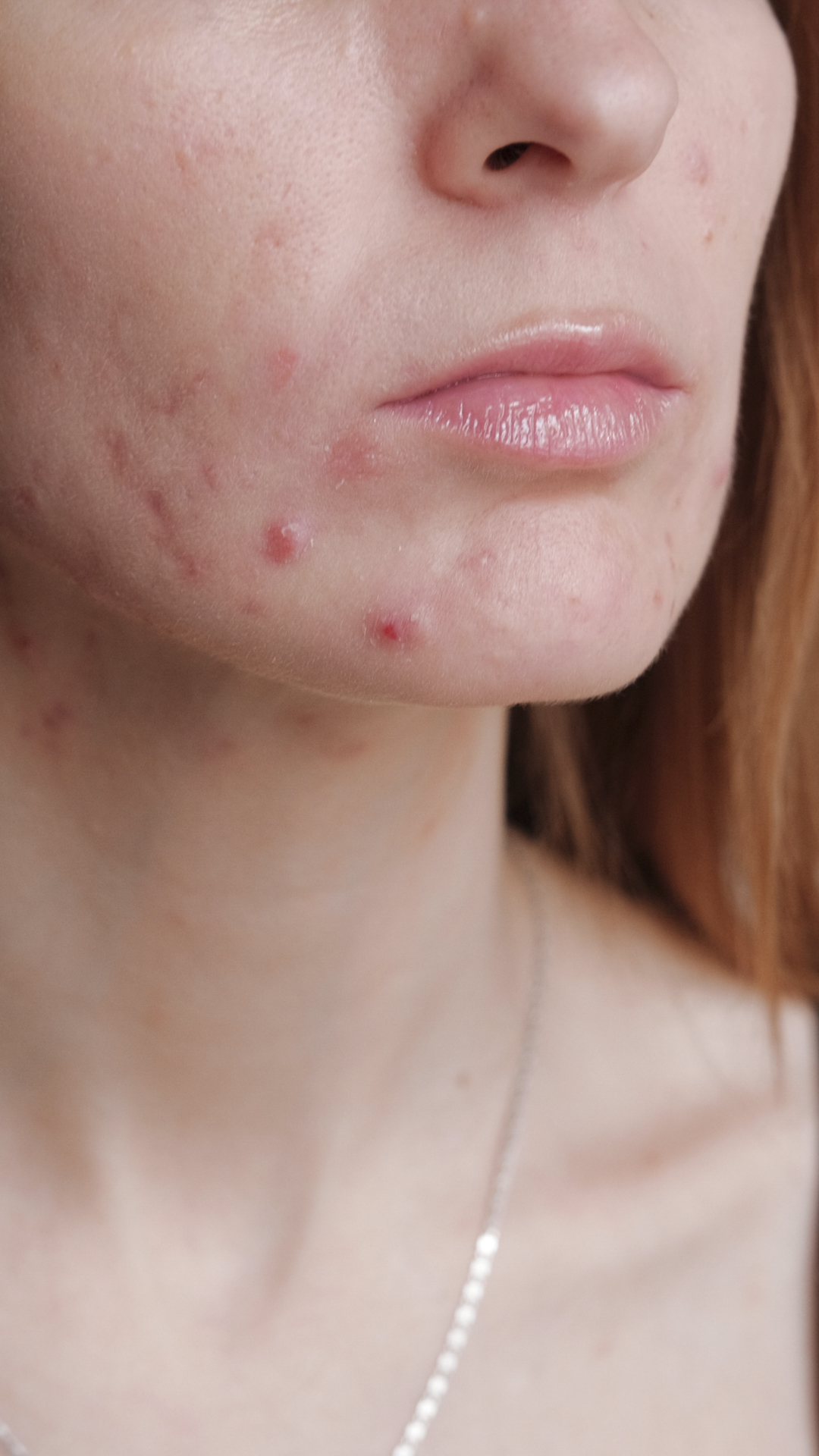 Tratamentos para cicatrizes de acne